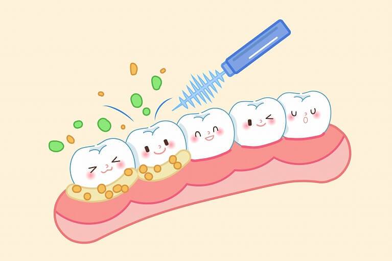 歯のクリーニングが必要な理由