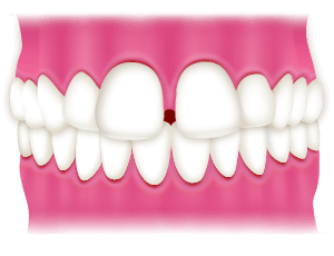 空隙歯列・正中離開