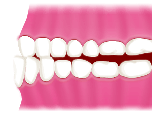 反対咬合・下顎前突