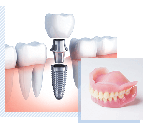 インプラントや入れ歯で 欠損歯の治療