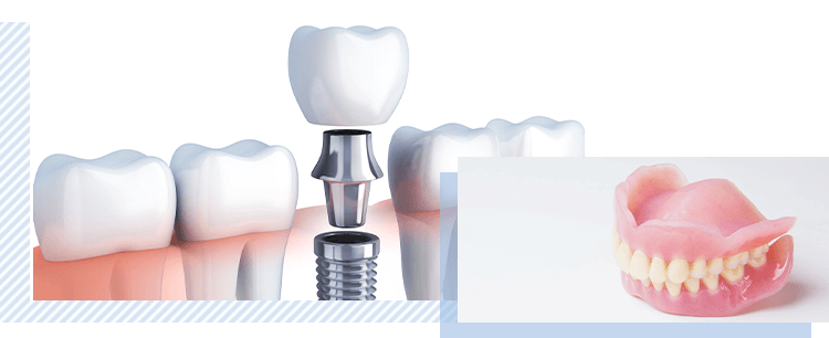 インプラントや入れ歯で 欠損歯の治療