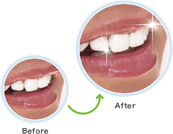 従来のホワイトニング